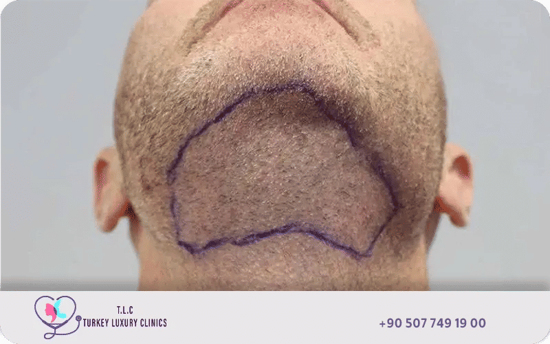 Close-up of beard donor area used as an alternative source for hair transplant grafts