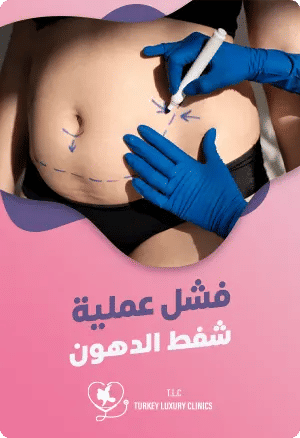 فشل عملية شفط الدهونfeatured image