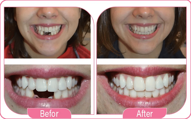 Front Tooth Dental Implant Before and After 2