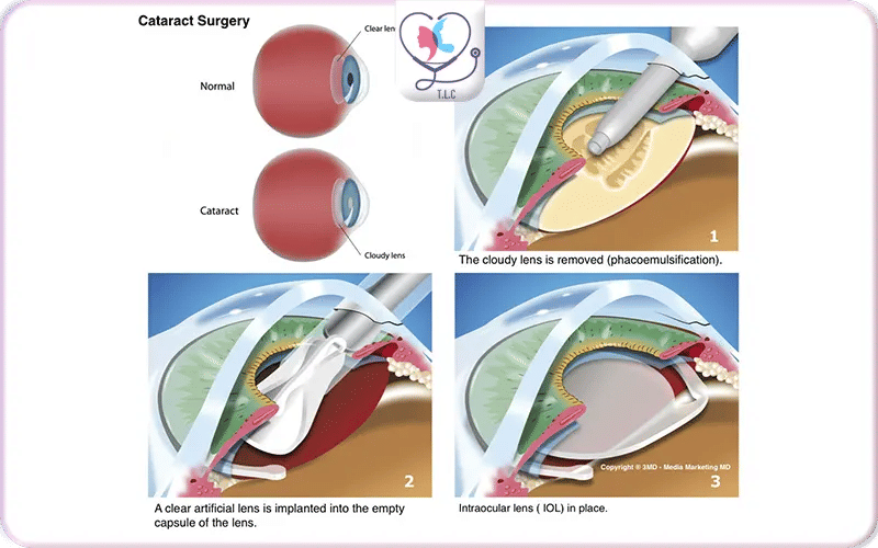 Cataract Surgery in Turkey At a Glance