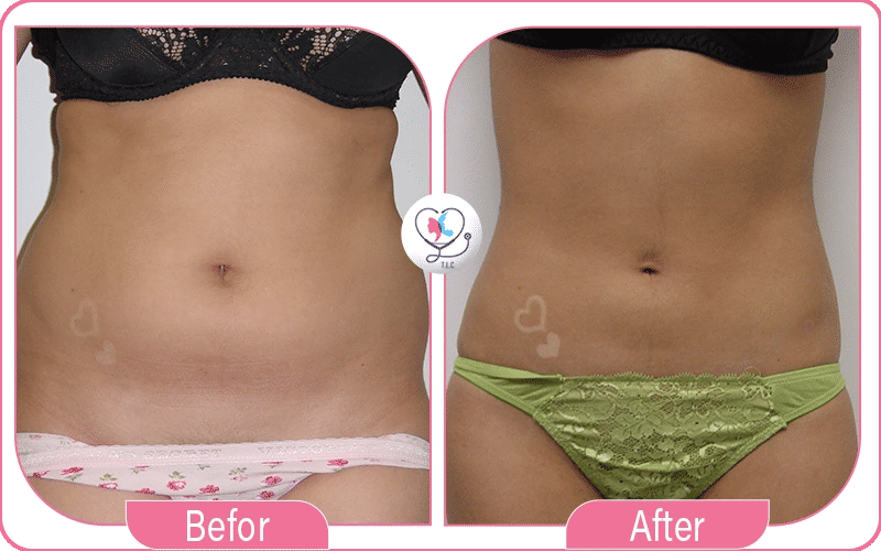 Returning to Daily Activities After Lipo 360