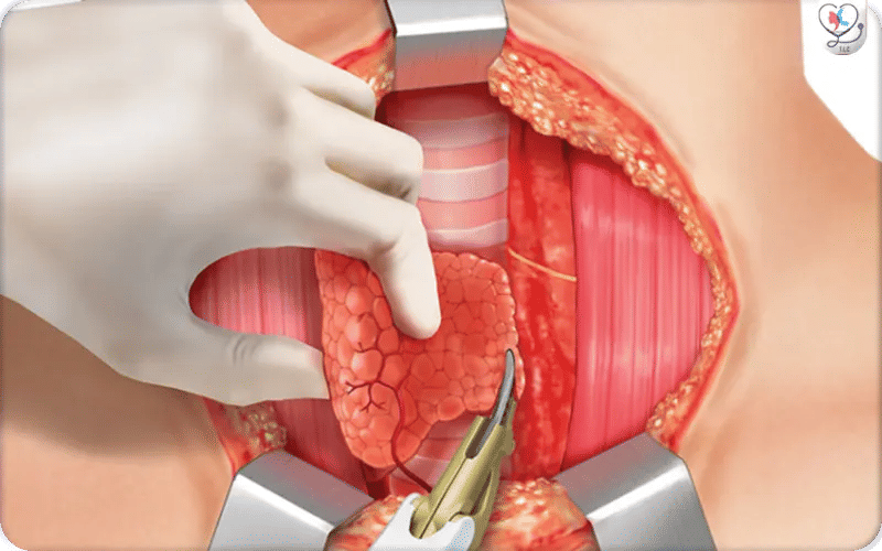 ما بعد استئصال الغدة الدرقية 