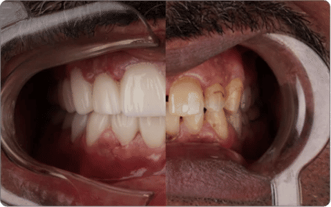 Before All-Inclusive Plastic Surgery Packages 2026 in Turkey, Mexico, and Brazil 1