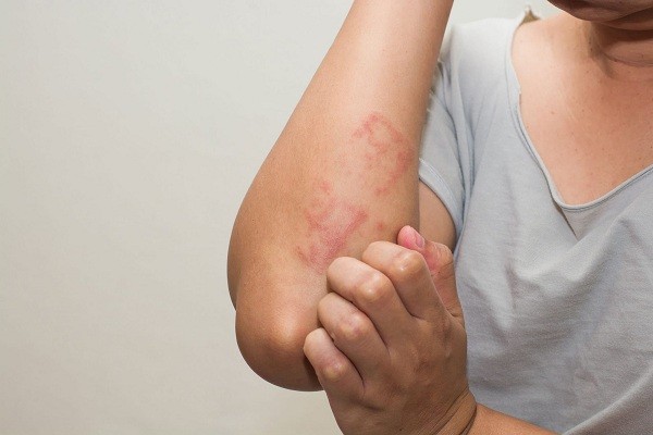 4 Macam Penyakit Alergi Kulit, Apa Gejala dan Cara Mengobatinya?