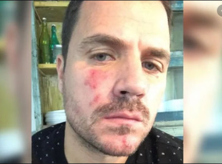 Dani Martín muestra su rosácea