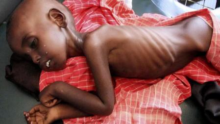 Farhiya Abdulkadir, de cinco años, tendido en una cama del hospital Banadir de Mogadiscio, Somalia, por problemas de malnutrición