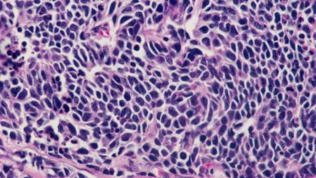 Células cancerígenas de pulmón.