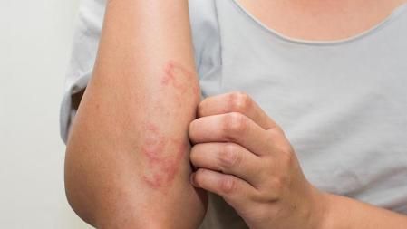 El eccema provoca picor en la mayoría de las ocasiones