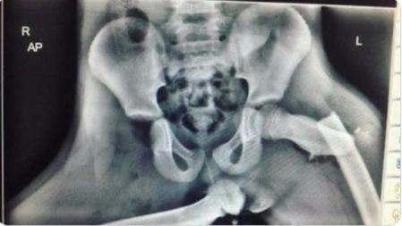 Radiografía en la que se observa un desprendimiento del fémur causado, según una sanitaria, por un accidente agravado por llevar los pies sobre el salpicadero 