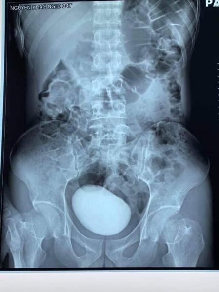 Las imágenes de la tomografía mostraron una enorme masa redonda alojada en su abdomen.