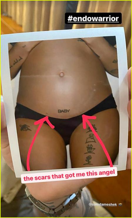 Halsey sobre su endometriosis