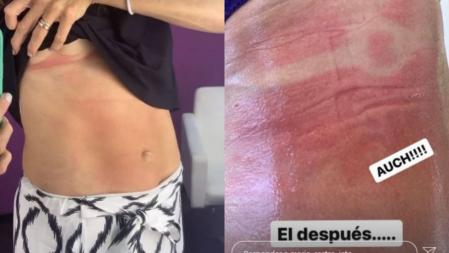 Quemaduras de María Castro