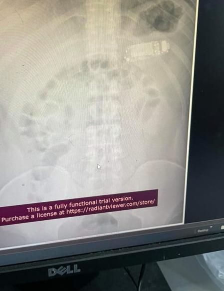 El hombre fue rápidamente operado de urgencias y todo se quedó en un susto