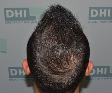 DESPUES de un injerto capilar