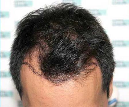 El antes de someterse a un trasplante de cabello