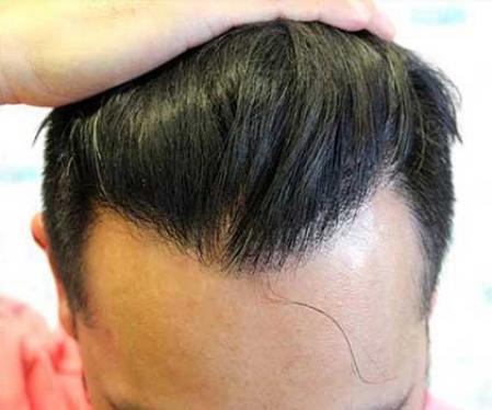 Después de someterse a un trasplante de cabello