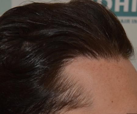 Después de someterse a un trasplante de cabello