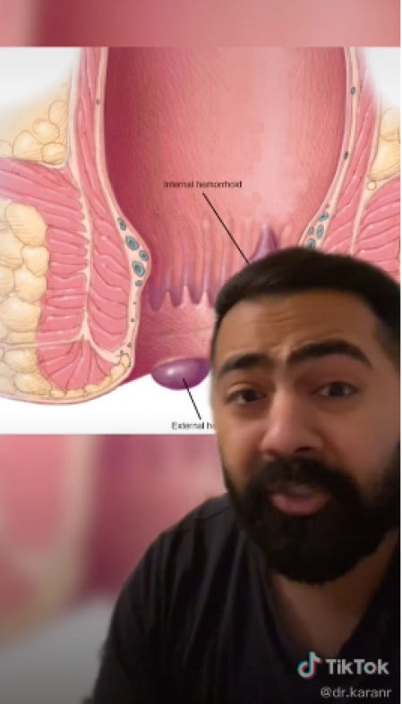 El doctor Karan Raj aporta unos sencillos trucos para evitar hemorroides