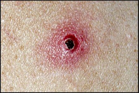 Infección por enfermedad de arañazo de gato  .