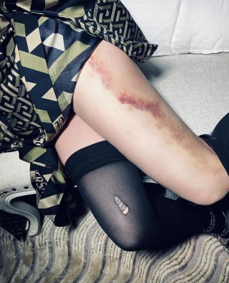 El moratón con el que aparece la artista preocupó a sus seguidores.