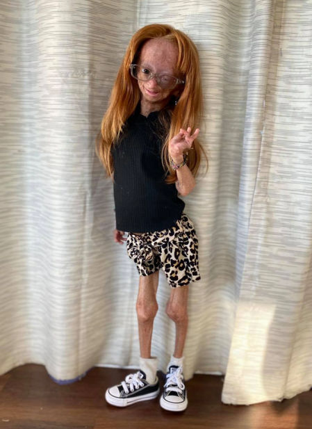 Adalia Rose tenía el Síndrome Hutchinson-Gilford