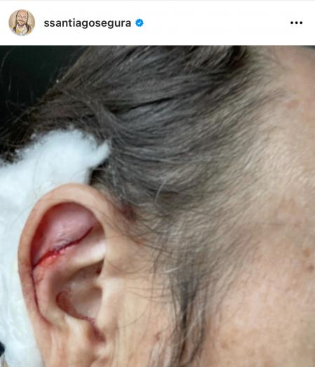 Santiago Segura compartió con sus seguidores las consecuencias de su desmayo