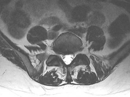 Imagen de una caso de artrosis facetaria