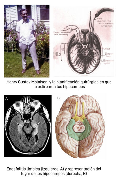 La extracción del hipocampo hace que no pueda transformarse la memoria a corto plazo en memoria a largo plazo