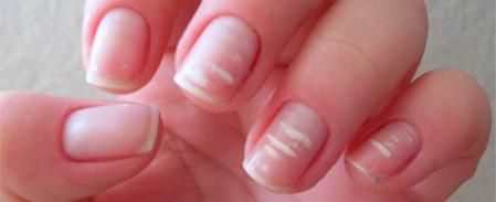 La leuconíquia no se tiene que confundir con otras manchas