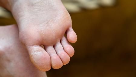 Es frecuente que los hongos se localicen en los pies