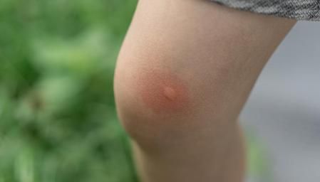 La gravedad de las picaduras dependen del insecto que nos ha picado