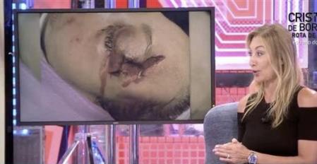 Así quedó el rostro de Mónica Pont tras su accidente