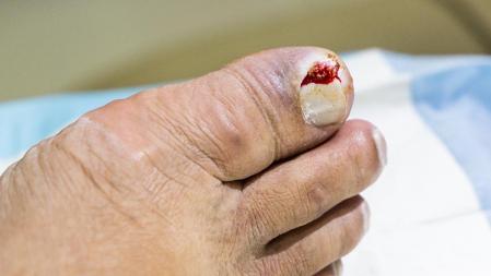 Un caso extremo encarnado