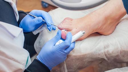 Es imprescindible acudir al podólogo para definir el tratamiento a seguir