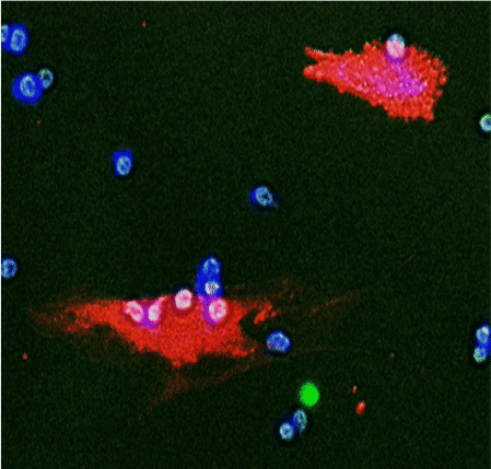Células del tumor atacadas por el sistema inmune en azul y blanco cuando entran en contacto