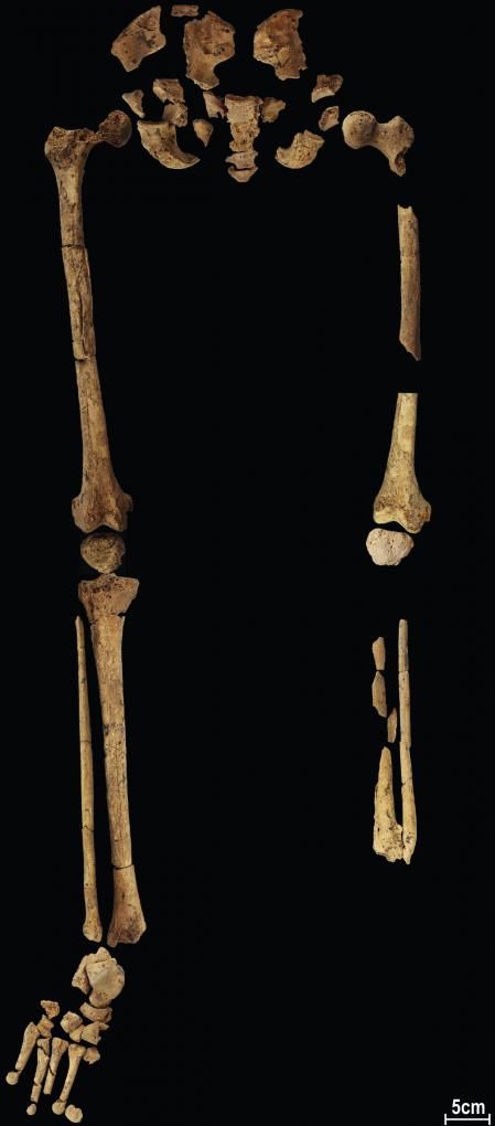 Huesos de los miembros inferiores del individuo al que amputaron la pierna izquierda por debajo de la rodilla en Borneo hace 31.000 años