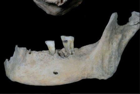 A la mandíbula de esta mujer de hace 2.000 años apenas le quedaban tres dientes