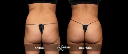 Se pueden moldear los glúteos, las piernas, la cintura y las caderas. También es posible eliminar los michelines, reducir la celulitis y atenuar la flaccide