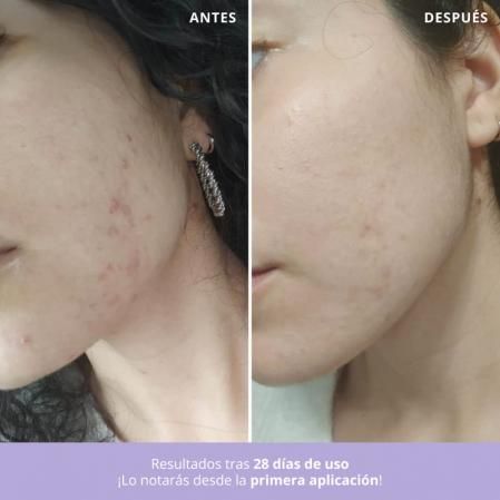 Antes y después de usar el tratamiento Azelaic Radiance Face Treatment.