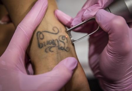 Las muñecas y dedos son zonas dolorosas en el borrado de tatuajes
