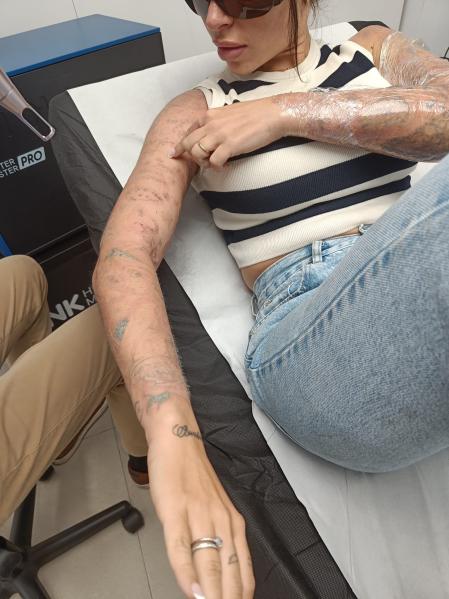 Paula Gallardo va por la cuarta sesión de láser para eliminar todos los tatuajes de sus brazos