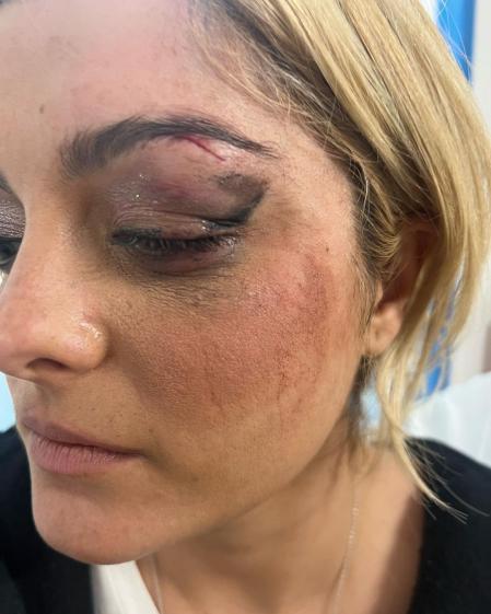 Bebe Rexha muestra las heridas en su ojo