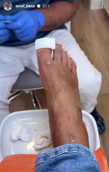 Detalle del pie de Asraf Beno tras su paso por Honduras