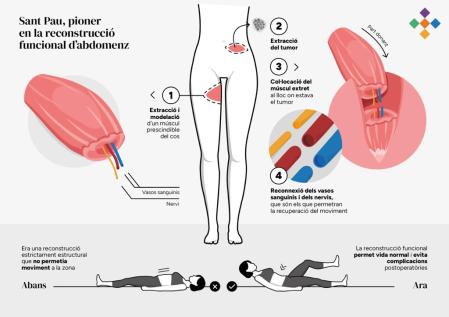 Esquema de la intervención