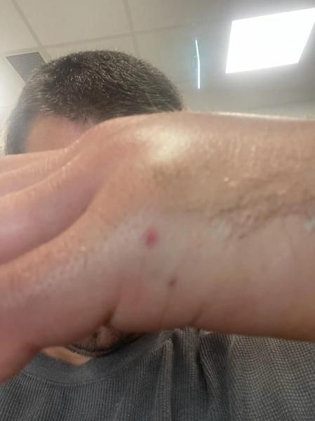 El cazador de serpientes local Ray McGibbon detalló la dolorosa experiencia en redes sociales