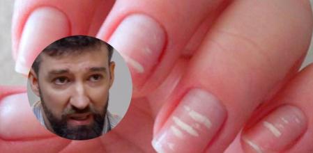 Un doctor revela qué son las manchas blancas que aparecen en las uñas: “No es falta de calcio”&nbsp;