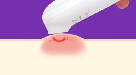 Un dispositivo para tratar las picaduras de insectos.