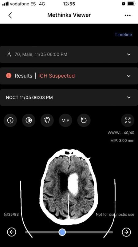 Hemorragia cerebral detectada (mancha central) en la aplicación MeThinks.