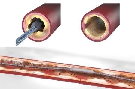 El sistema Stealth 360 implantado en el Hospital de Mataró .