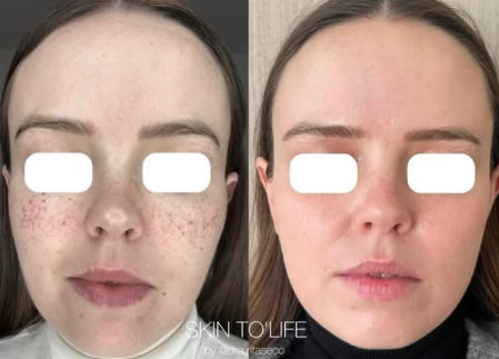 Tratamiento láser SKIN TO'LIFE por la Doctora Rita Sêco